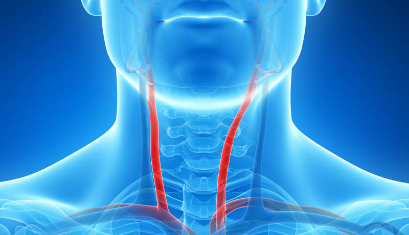 Clogged Artery Model, English-Spanish